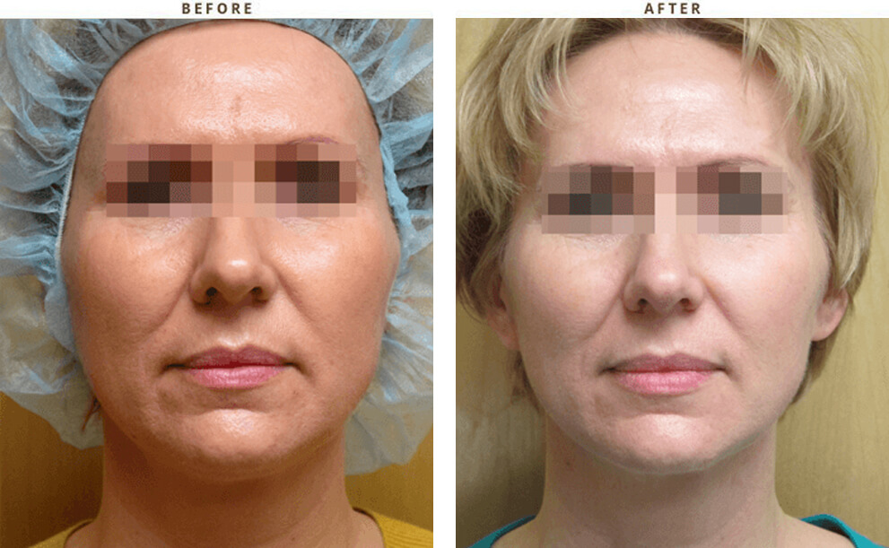 Non invasive Chicago - Before & After Pictures - Dr Gregory Turowski