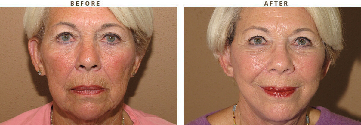 Facelift Chicago - Before & After Pictures - Dr Gregory Turowski