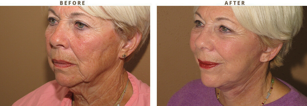 Facelift Chicago - Before & After Pictures - Dr Gregory Turowski