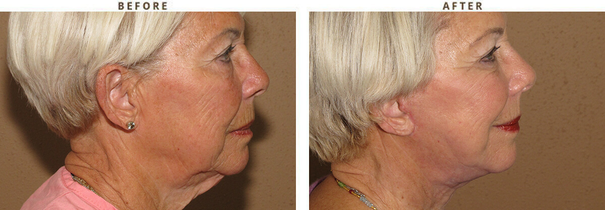 Facelift Chicago - Before & After Pictures - Dr Gregory Turowski