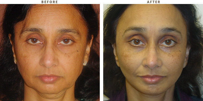 Complex Facial Rejuvenation Chicago - Before & After Pictures - Dr Gregory Turowski