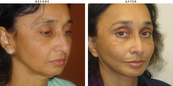 Complex Facial Rejuvenation Chicago - Before & After Pictures - Dr Gregory Turowski