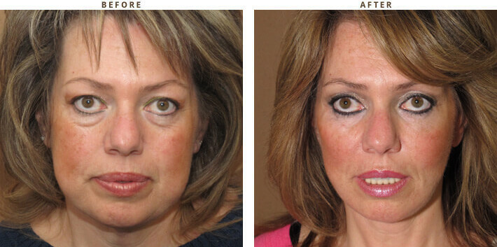 Complex Facial Rejuvenation Chicago - Before & After Pictures - Dr Gregory Turowski