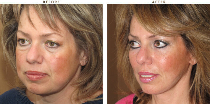 Complex Facial Rejuvenation Chicago - Before & After Pictures - Dr Gregory Turowski