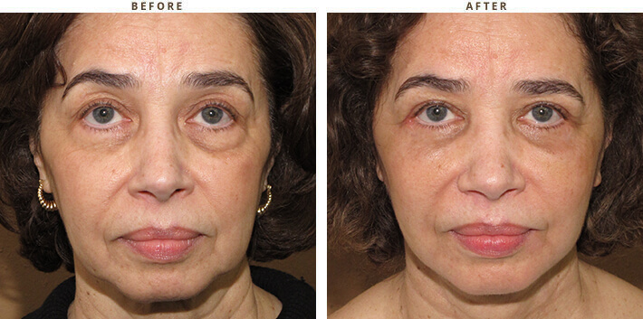 Complex Facial Rejuvenation Chicago - Before & After Pictures - Dr Gregory Turowski