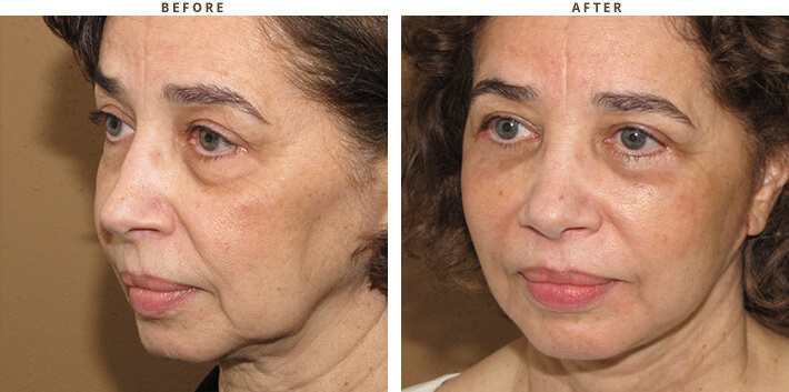 Complex Facial Rejuvenation Chicago - Before & After Pictures - Dr Gregory Turowski