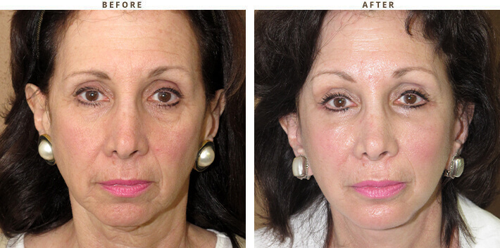 Complex Facial Rejuvenation Chicago - Before & After Pictures - Dr Gregory Turowski