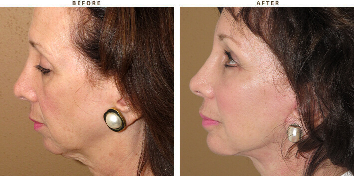 Complex Facial Rejuvenation Chicago - Before & After Pictures - Dr Gregory Turowski