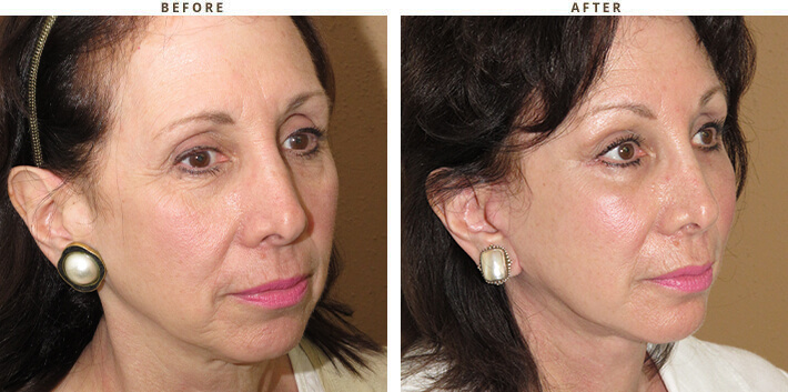 Complex Facial Rejuvenation Chicago - Before & After Pictures - Dr Gregory Turowski