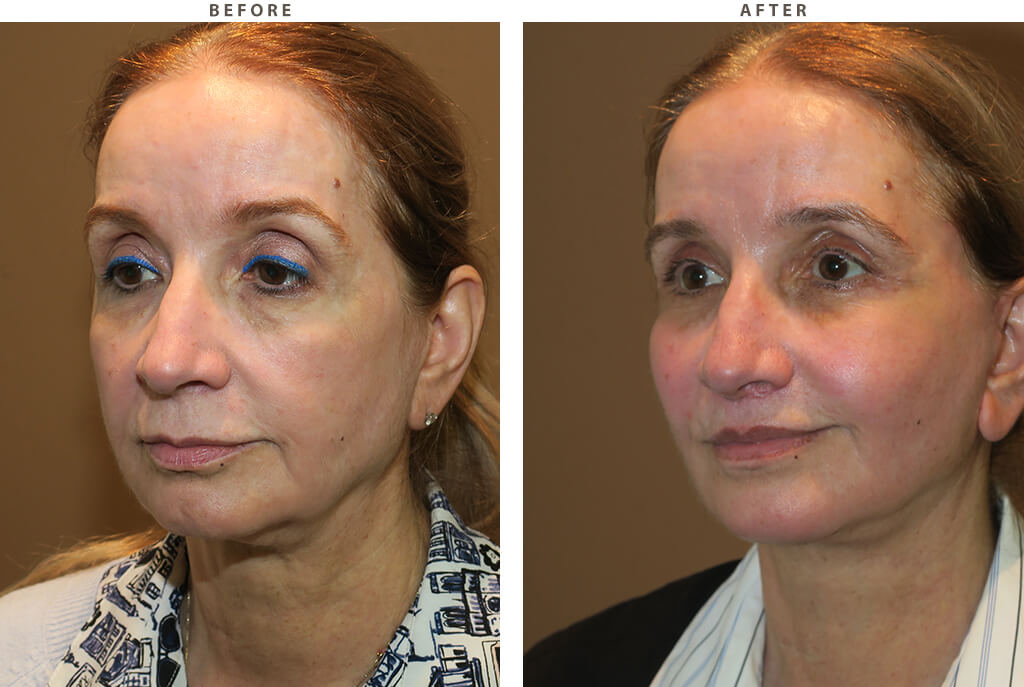 Complex facial rejuvenation