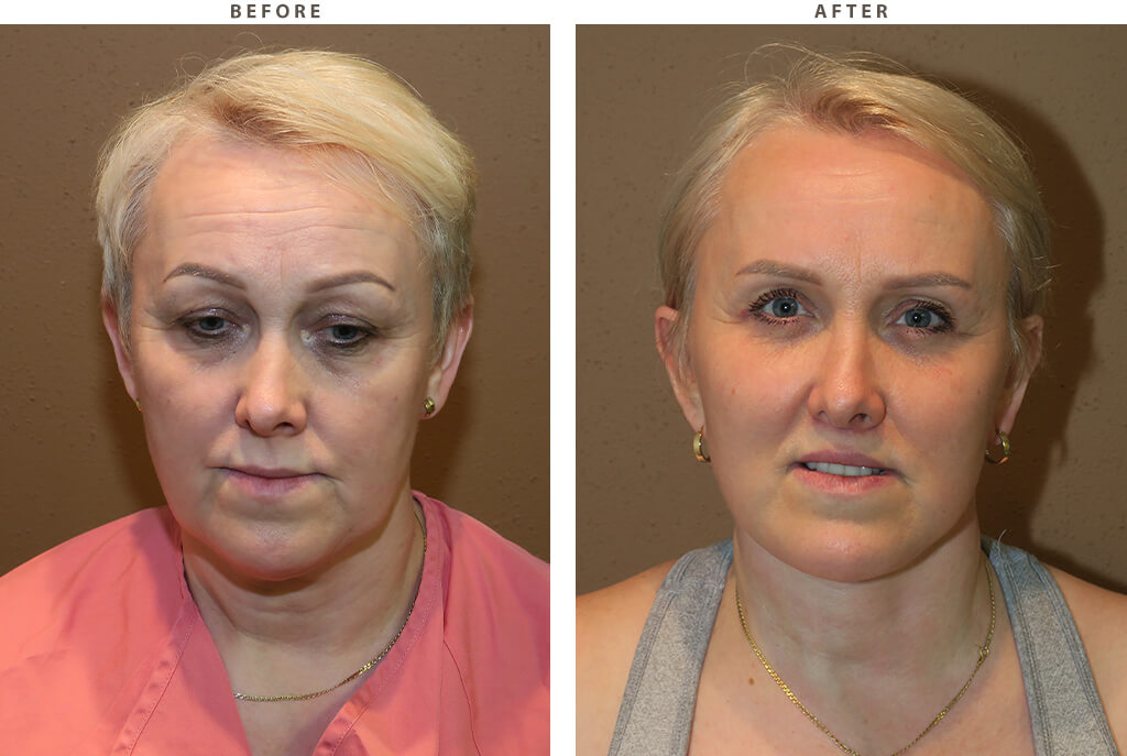 Complex facial rejuvenation