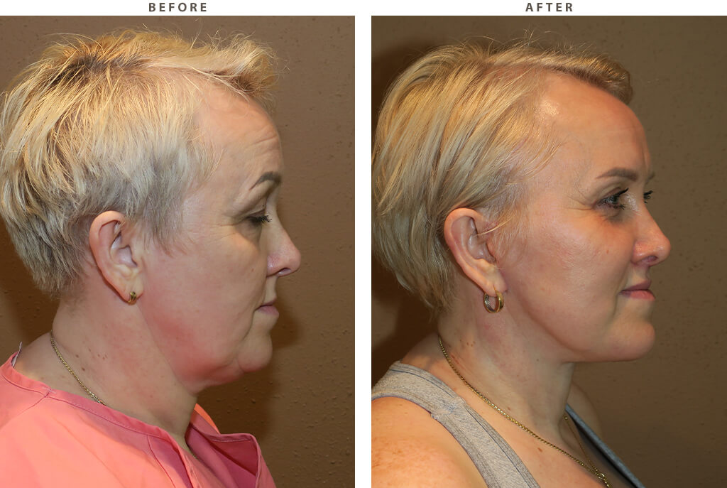 Complex facial rejuvenation