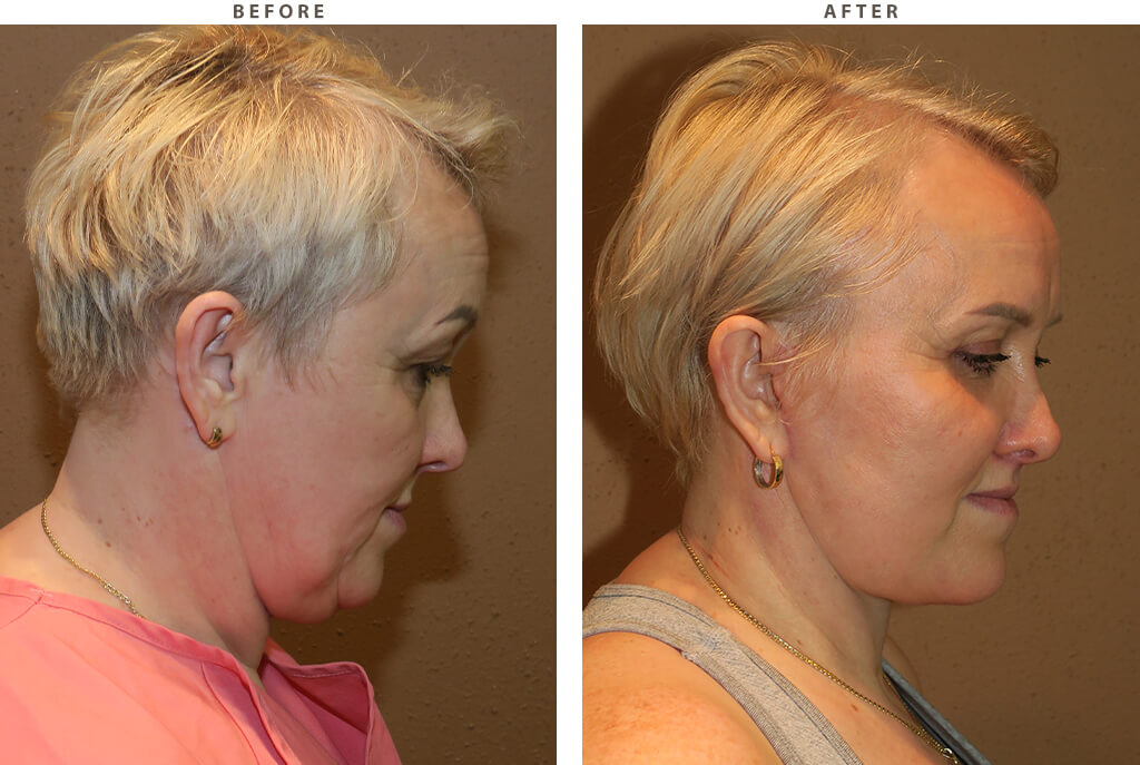Complex facial rejuvenation