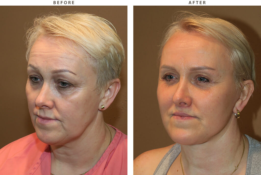 Complex facial rejuvenation