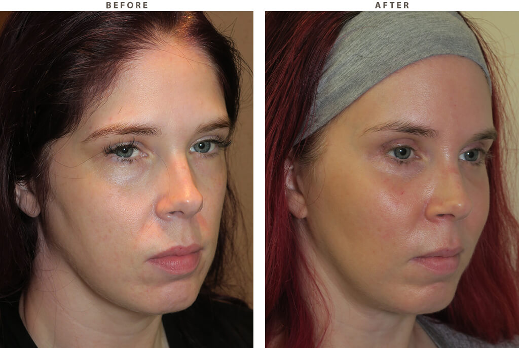 Malar (cheek) implants
