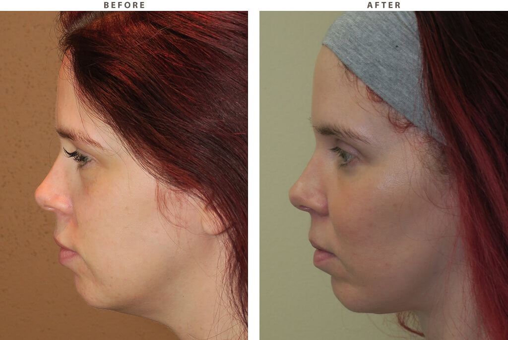 Malar (cheek) implants