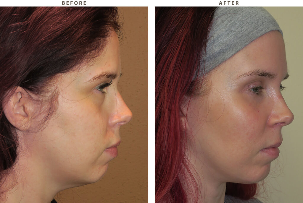 Malar (cheek) implants