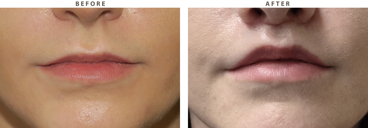 7114-lip-lift-chicago-before-after-01