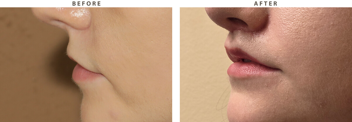 7114-lip-lift-chicago-before-after-02