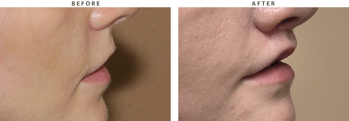 7114-lip-lift-chicago-before-after-03